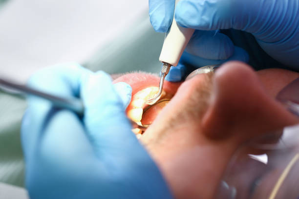 Best Emergency Wisdom Tooth Extraction in Curtice, OH
